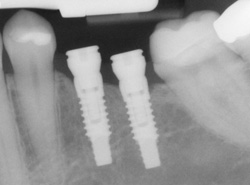 Dental implant restoration